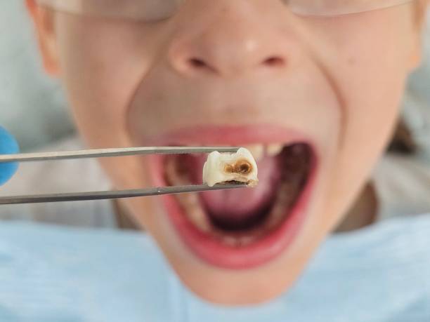 Best Emergency Treatment for Dental Infections or Abscesses in Paloma Creek South, TX